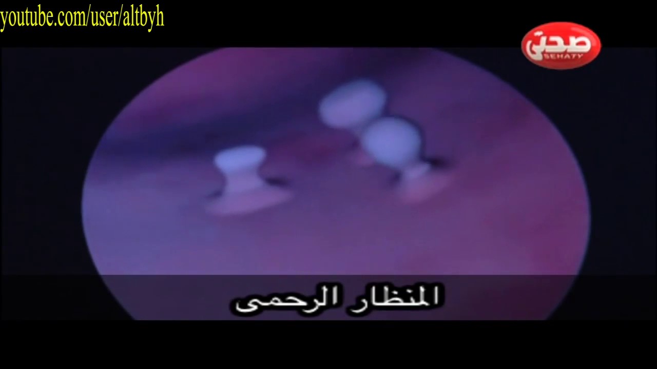 hysteroscopy ما هو المنظار الرحمي وفوائدة وكيف تتم عملية الكشف داخل الرحم