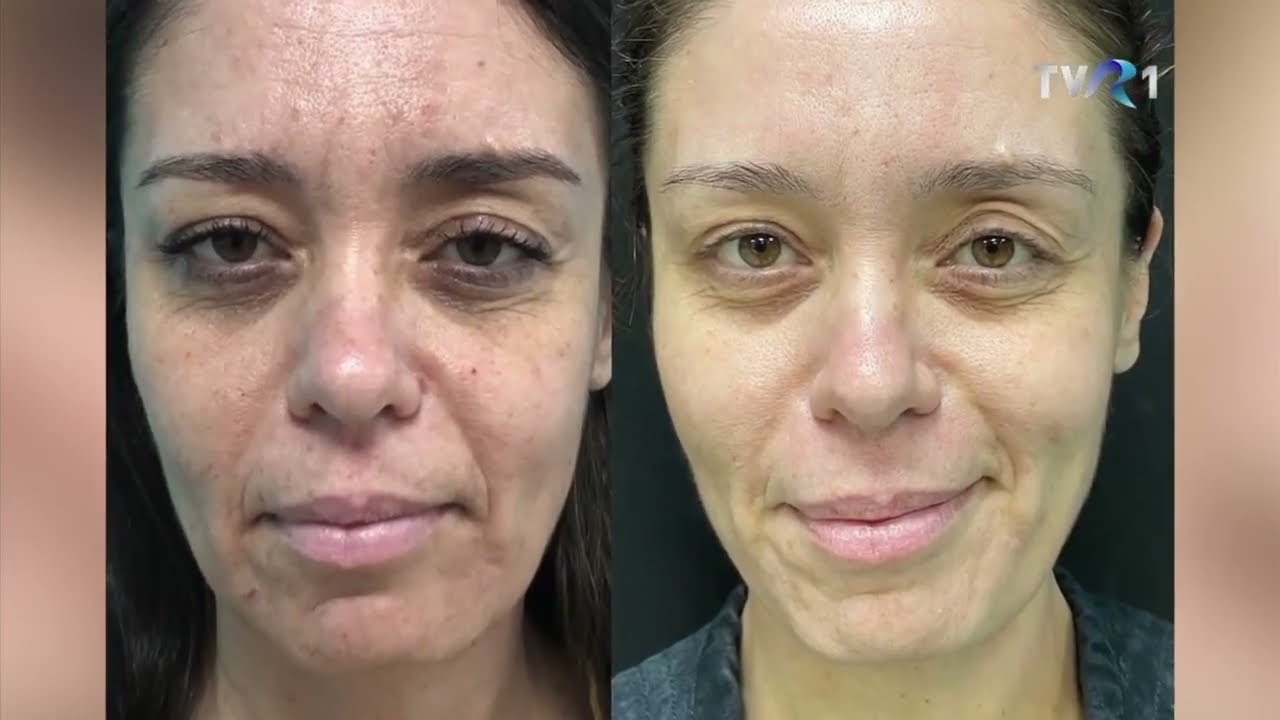 Sezonul rece este cel mai potrivit să ne ocupăm de petele pigmentare | DermaBeauty Clinique