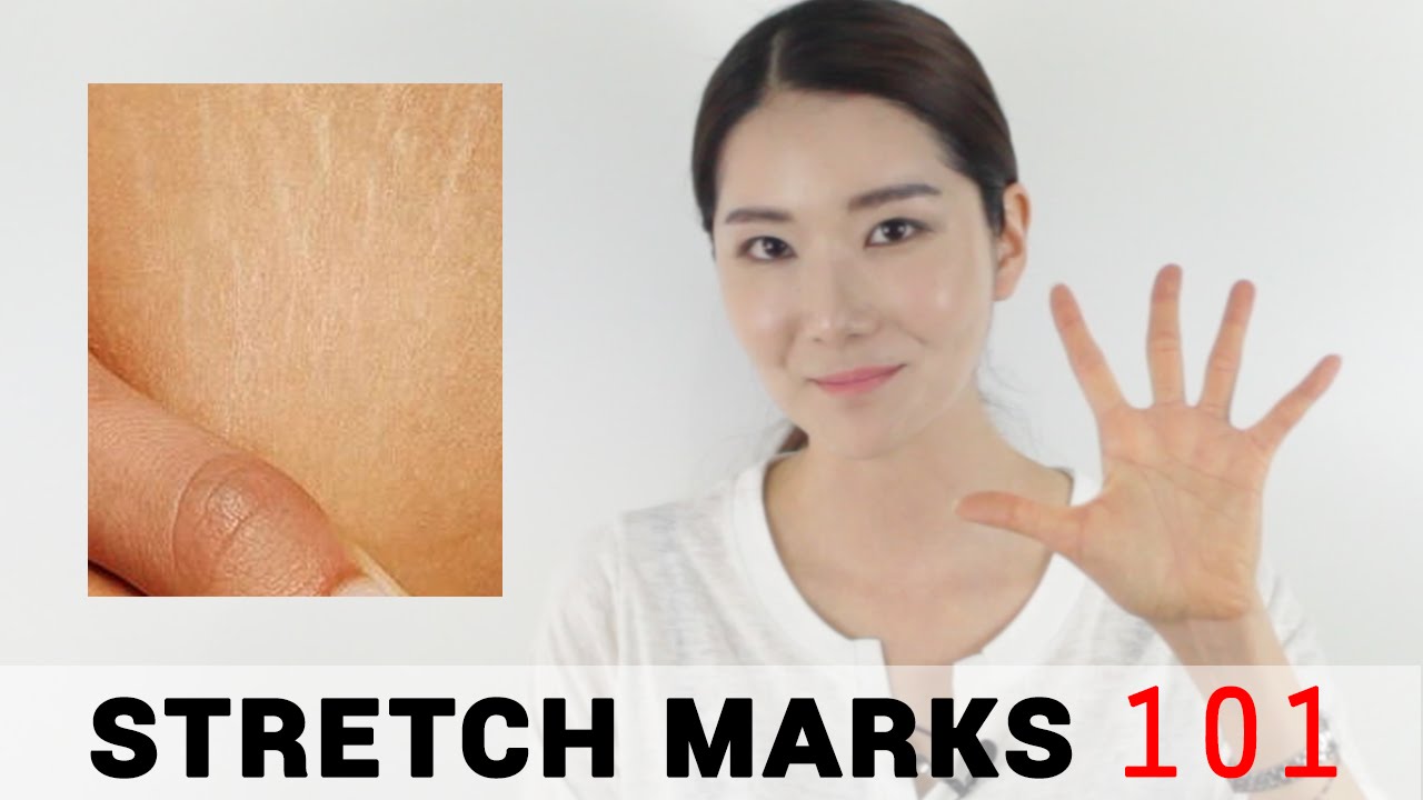 5 Essential Tips for Stretch Marks | Wishtrend
