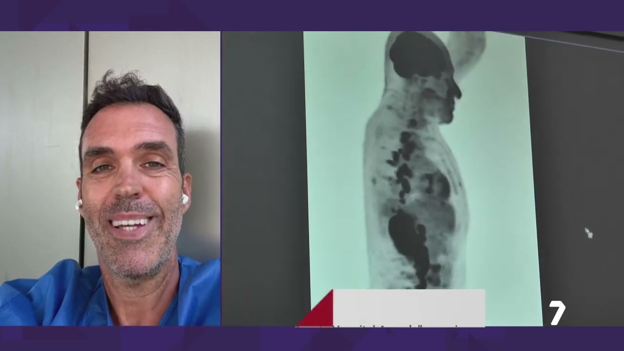 Entrevista en La7tv al Dr. Javier Pérez Pallarés (Neumólogo HLA La Vega)