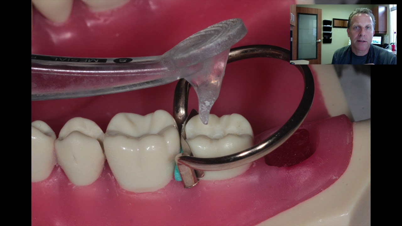 Class II Fillings - Tips & Tricks