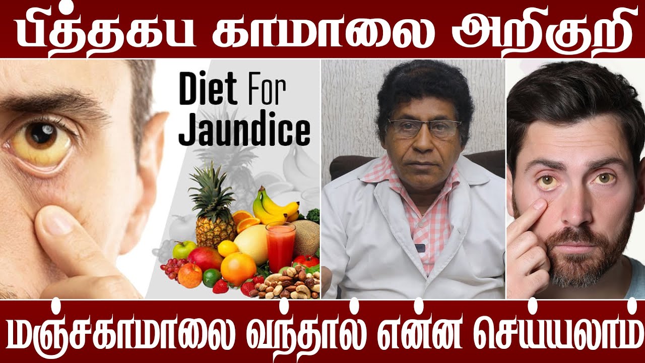 பித்த கப காமாலையின் அறிகுறிகள் - Dr.மோகன் ஆனந்தன் |  how to find jaundice | Dr Mokhan Anandhan TV