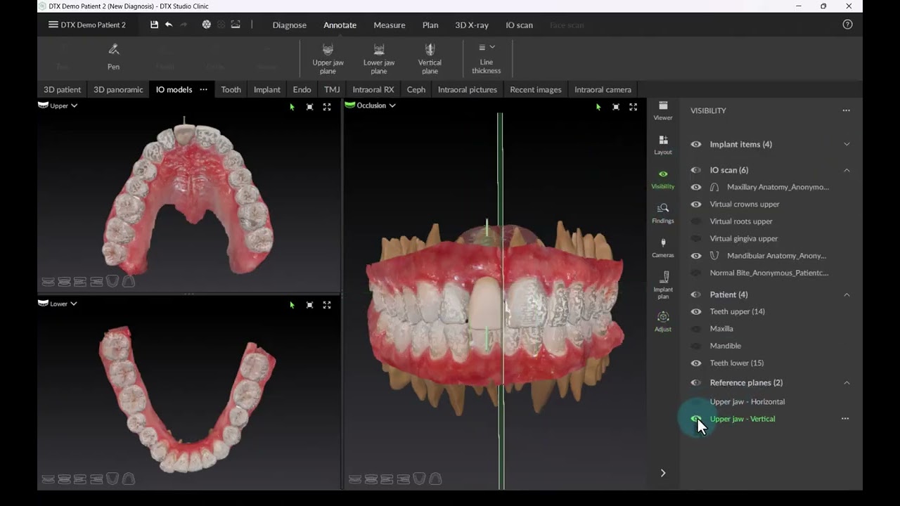 DTX Studio - Implant Extension Module