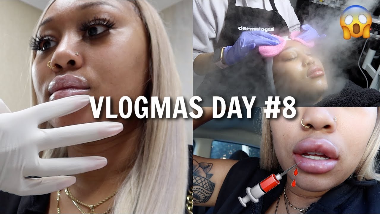 Come With Me to Get Lip Fillers | Vlogmas Day #8