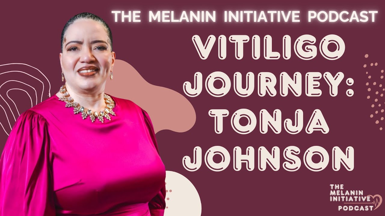 Tonja Johnson's Inspiring Vitiligo Journey