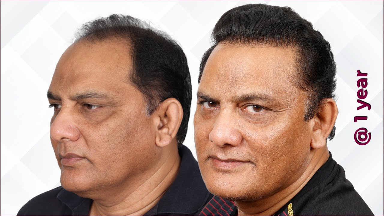 1-Year Mohammad Azharuddin Hair Transplant Progress - NW 5A, 4240 Grafts