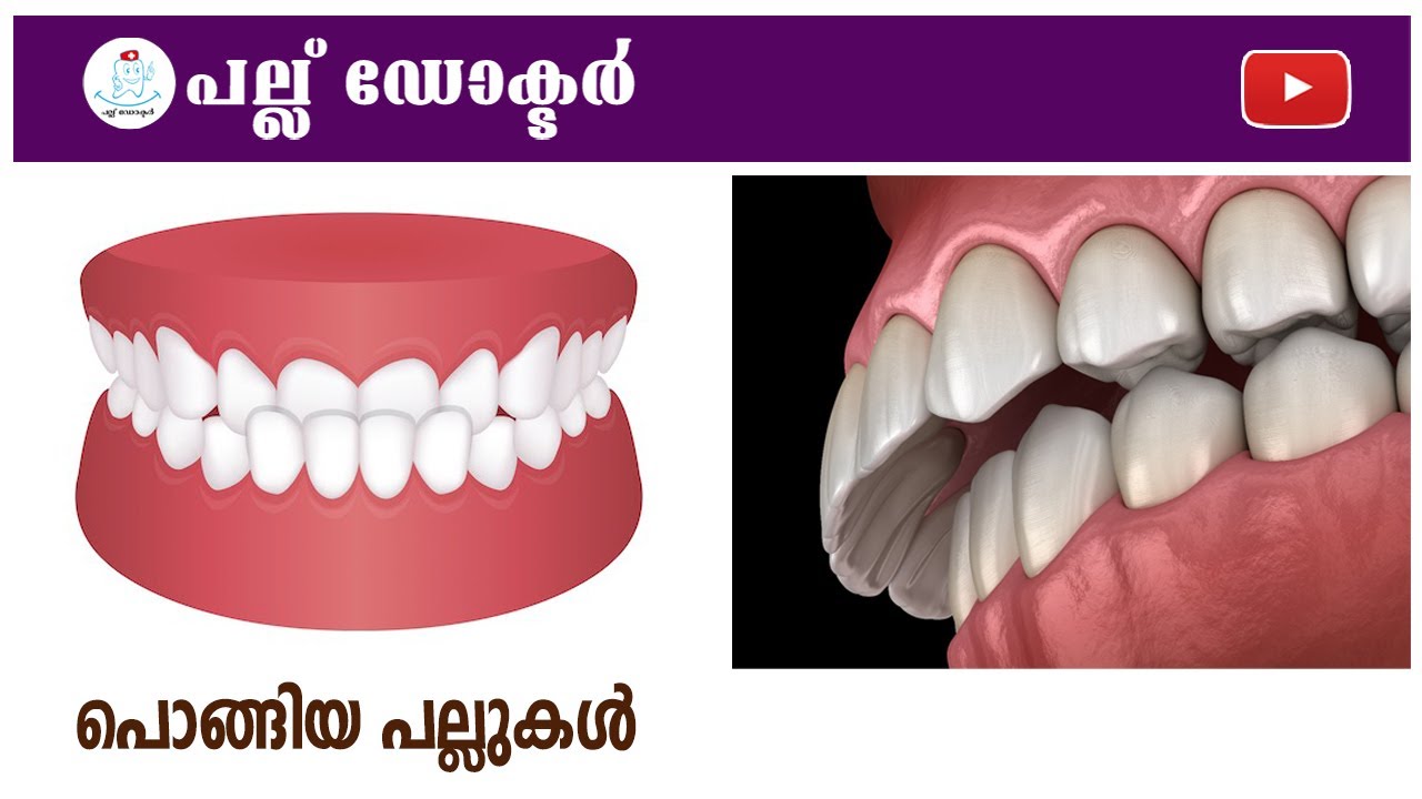 പൊങ്ങിയ പല്ലുകൾ  / 