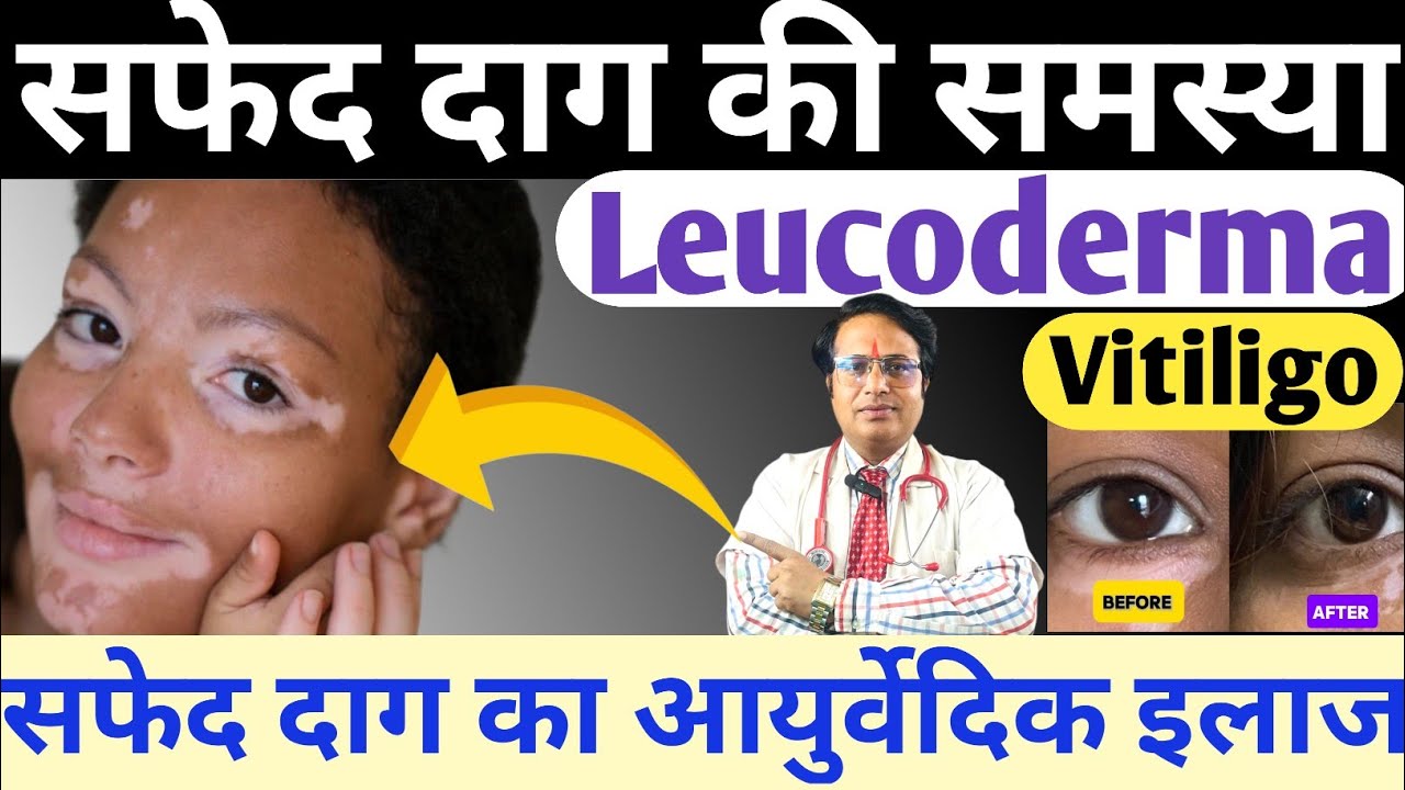 सफेद दाग की समस्या Leucoderma  Vitiligo || सफेद दाग का आयुर्वेदिक इलाज || Vitiligo Treatment At Home