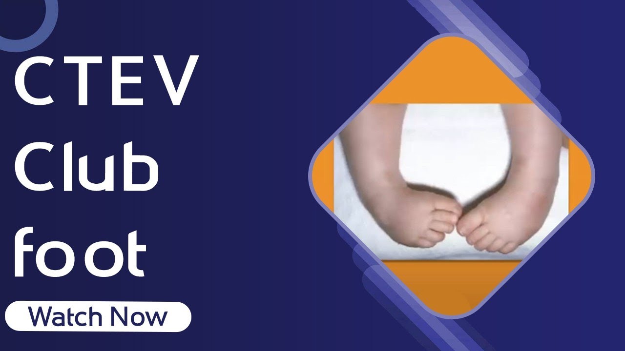CTEV/Club Foot 2024 | Orthopaedic Academy