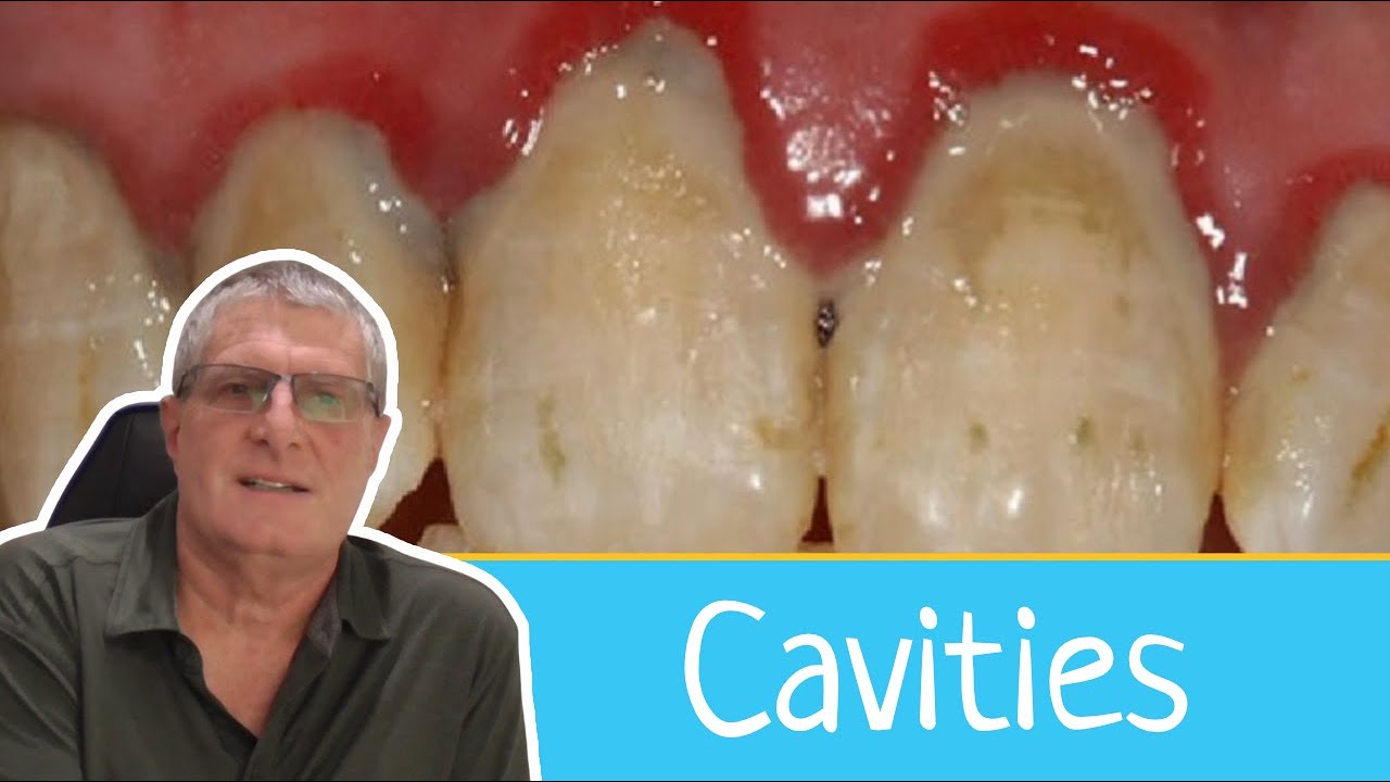 Some People who don't brush don't get cavities!