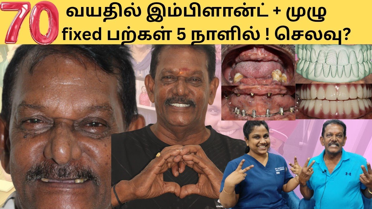 முழுவாய் இம்பிளான்ட் + Fixed நீண்டகால பல் சிகிச்சை! மொத்த சிகிச்சை அனுபவம் , செலவு#dentalimplants