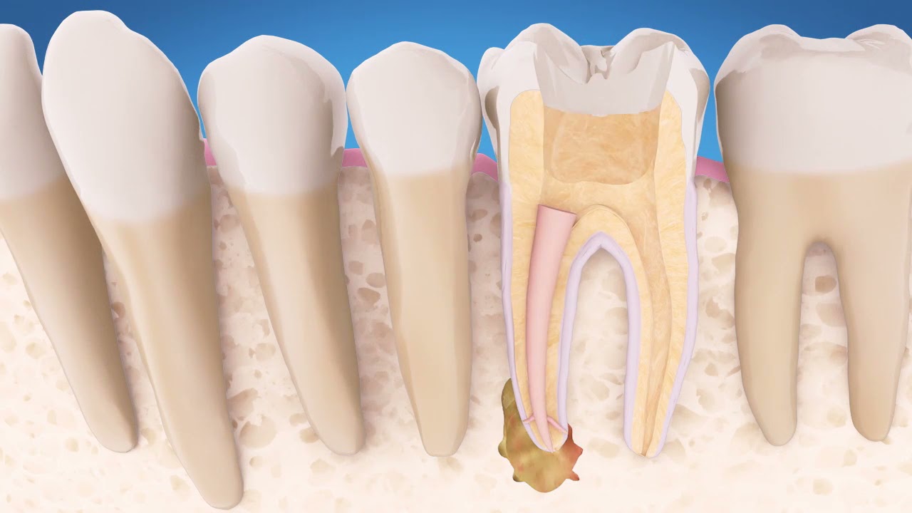 AAE Endodontic Retreatment Explained #Endodontics #Retreatment #RootCanals