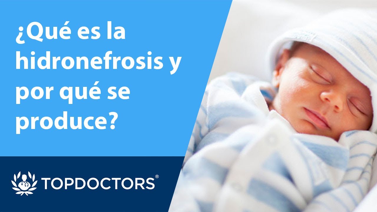 &iquest;Qu&eacute; es la hidronefrosis y por qu&eacute; se produce? (1/4)