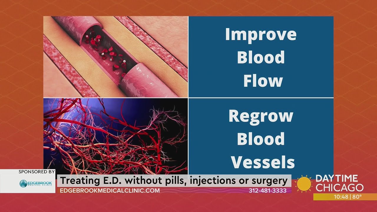 Treating E.D. without pills, injections or surgery