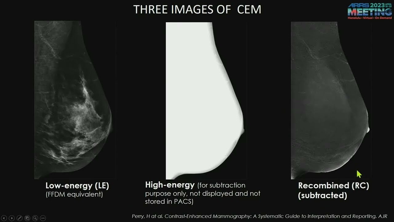 Contrast Enhanced Mammography - Course Sample