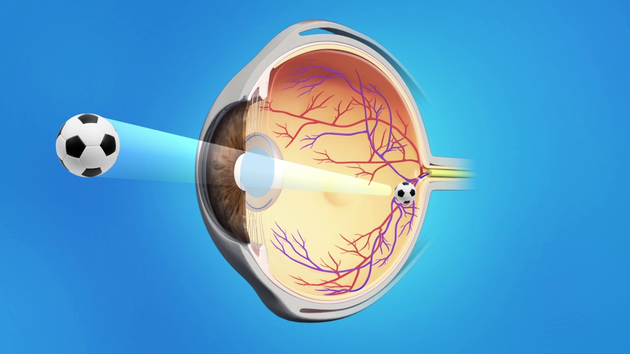 Cataract Surgery with a Multifocal Lens