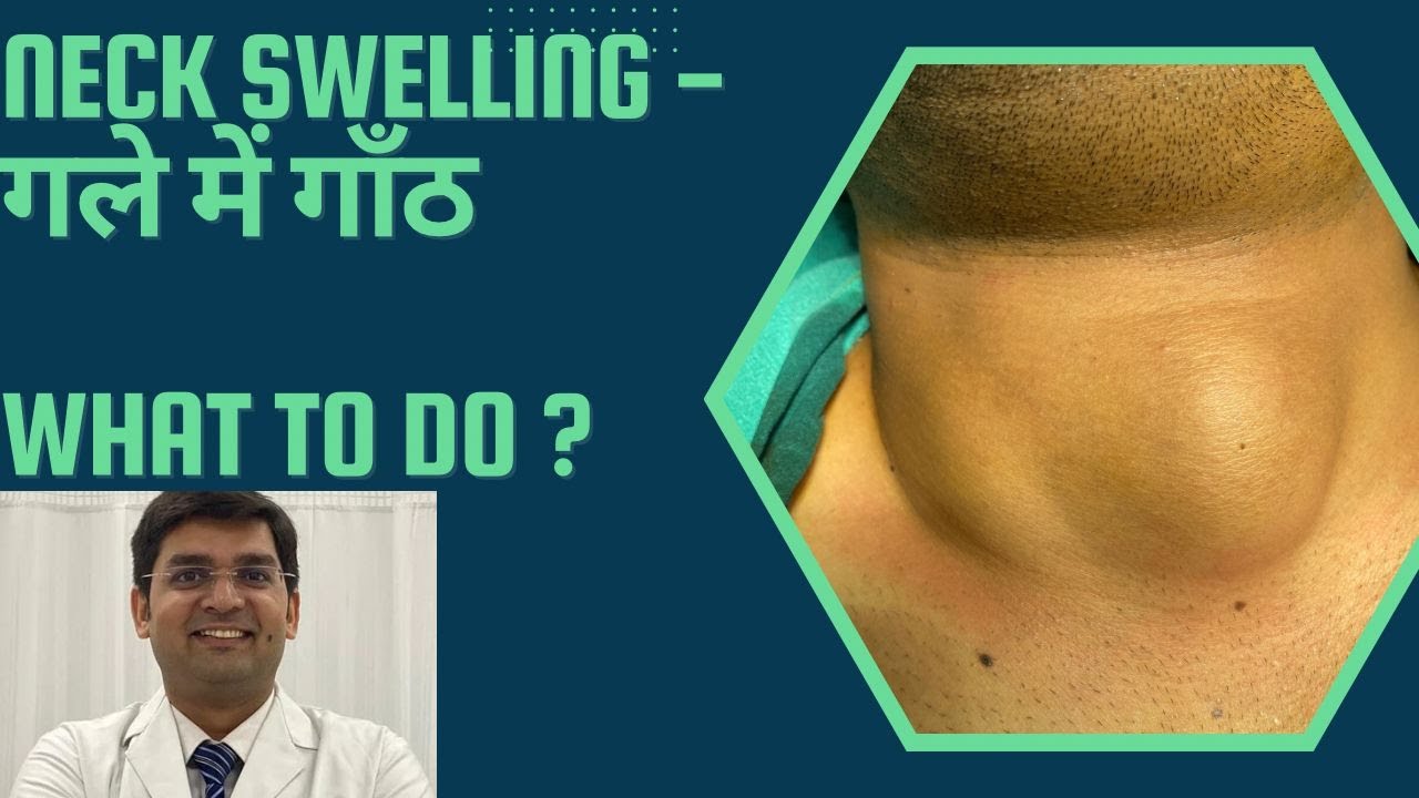 Neck swelling -  गर्दन / गले मे गाँठ - क्या करे - what to do || Dr Yash Chaddha
