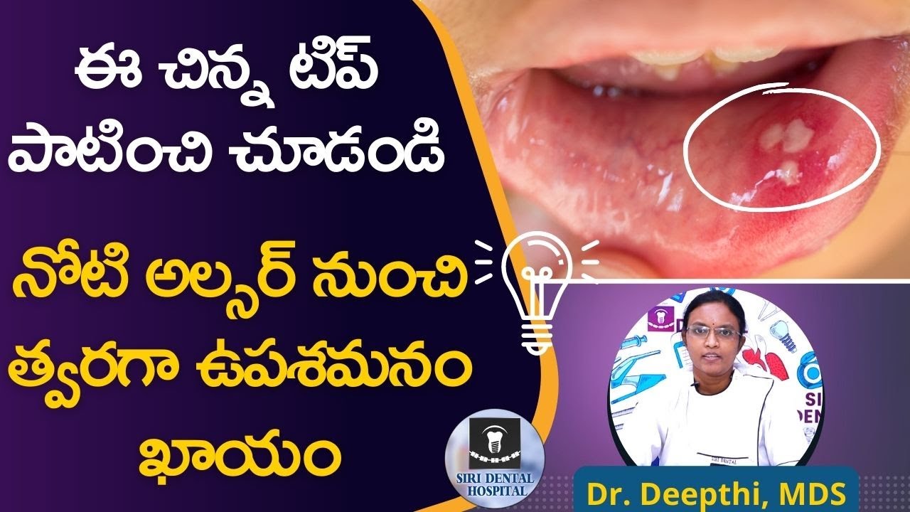 నోటి అల్సర్‌కు కారణాలు,చికిత్సా మార్గాలు | How To Get Rid Of Mouth Ulcers | Siri Dental Hospital