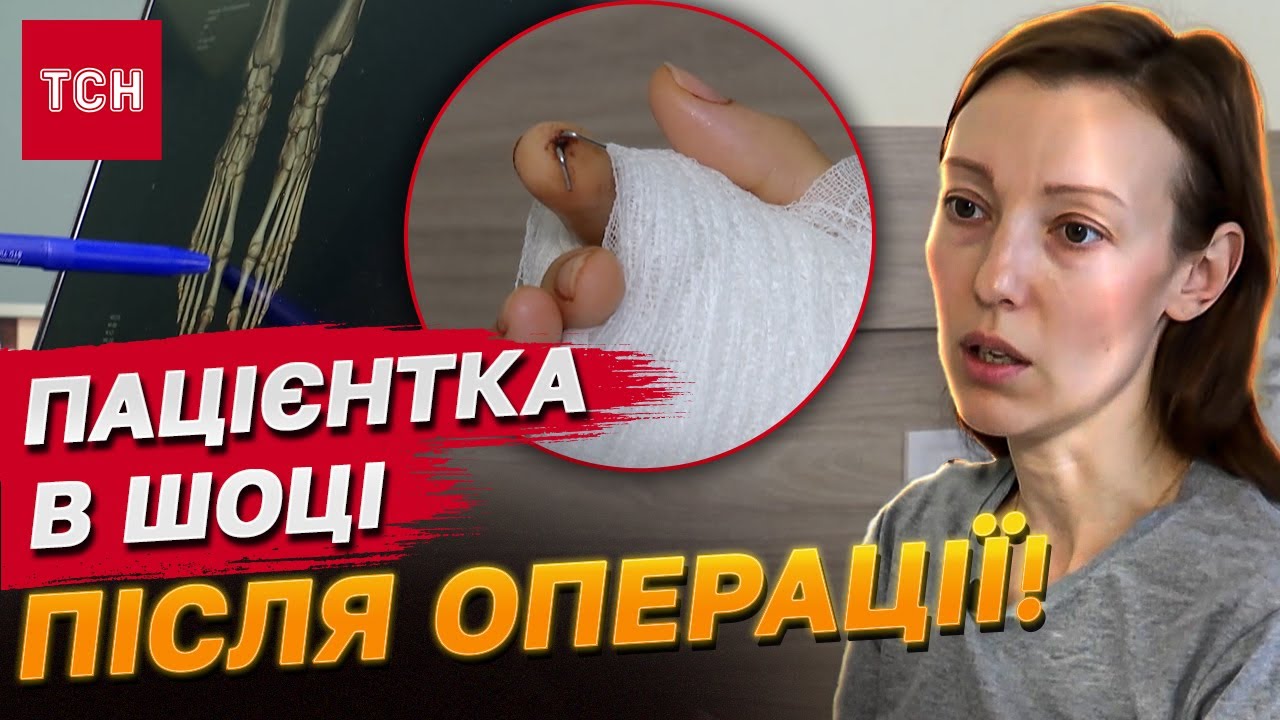 Пересадили ПАЛЕЦЬ З НОГИ НА РУКУ! Унікальна операція в Україні! Емоції пацієнтки ВРАЖАЮТЬ!
