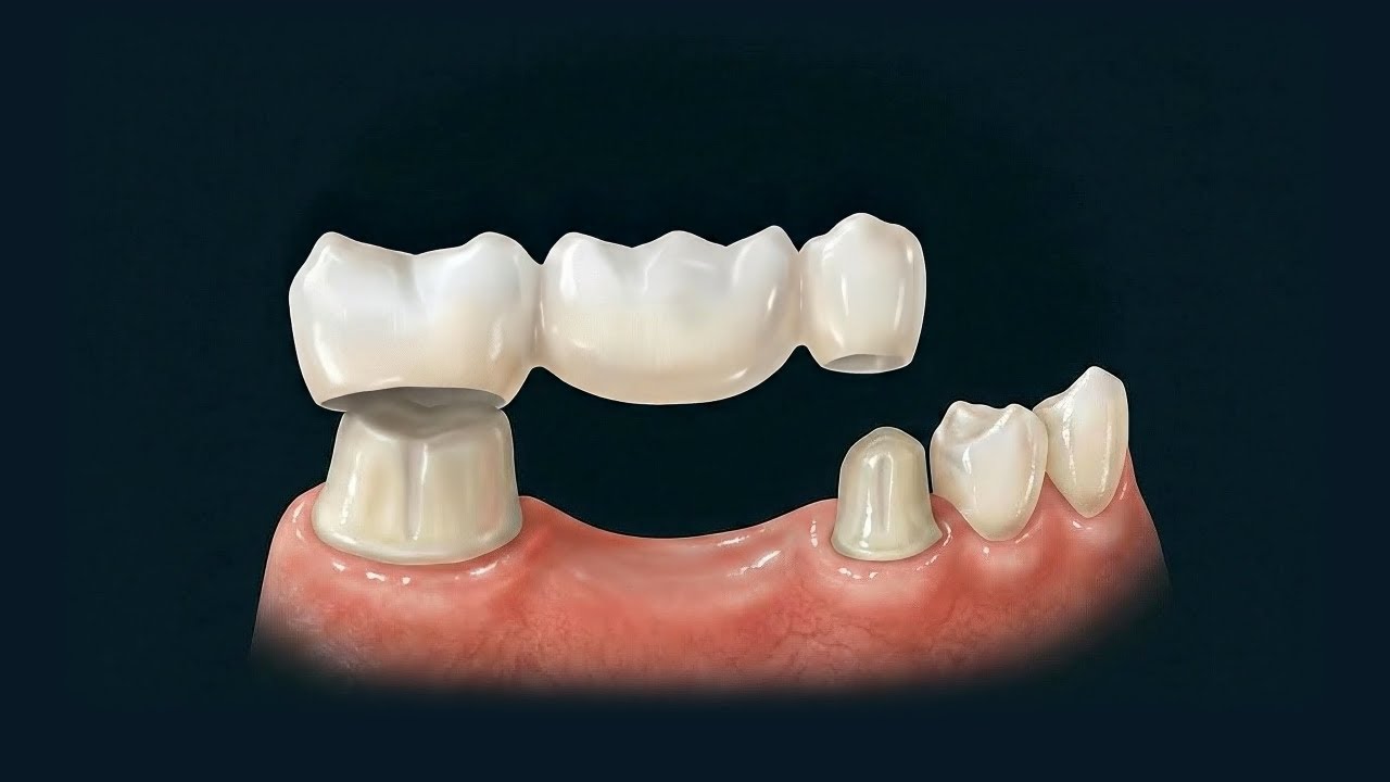 Dentures vs. Dental Implants
