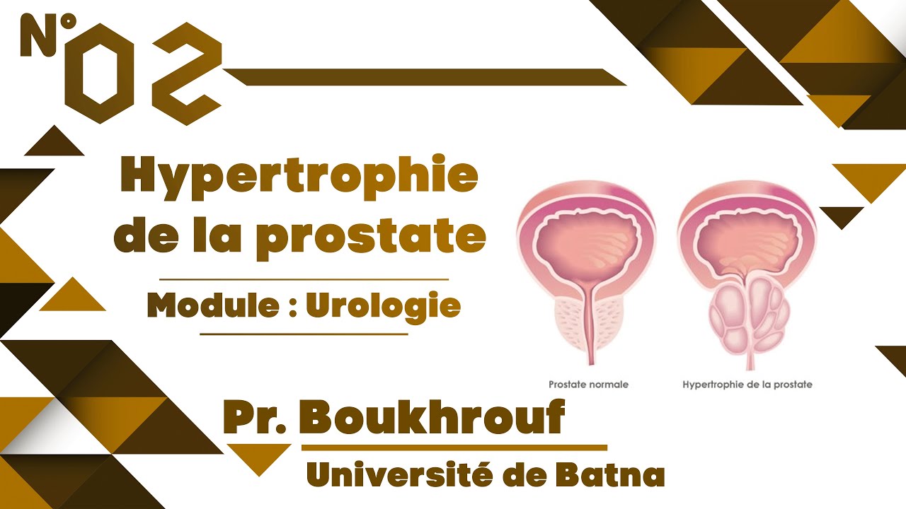 #Uro | 02. Hypertrophie de la prostate -Batna- (Pr Boukhrouf)