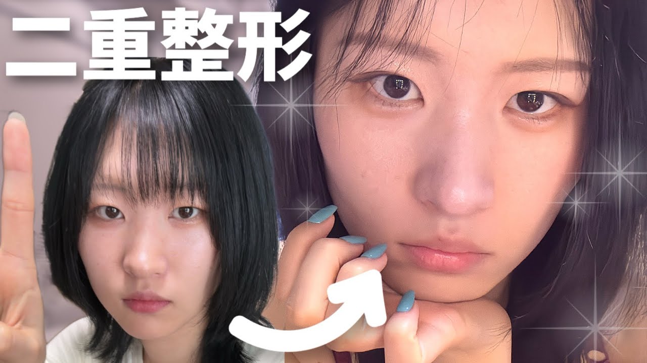 コンプレックスを一つ解消の巻【二重埋没しました】