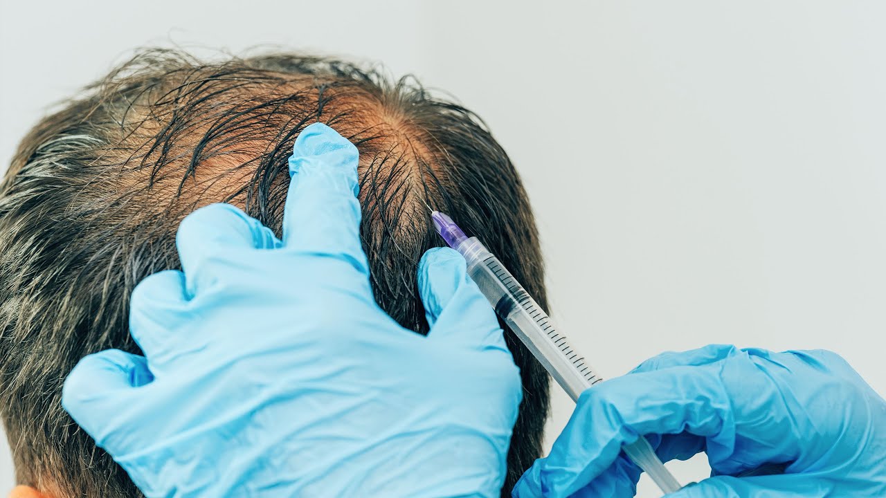 Nerve pain after a hair transplant procedure.