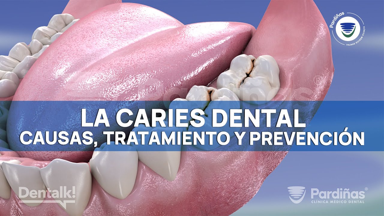 CARIES DENTAL - Causas, prevenci&oacute;n y TRATAMIENTO de los dientes picados &copy;