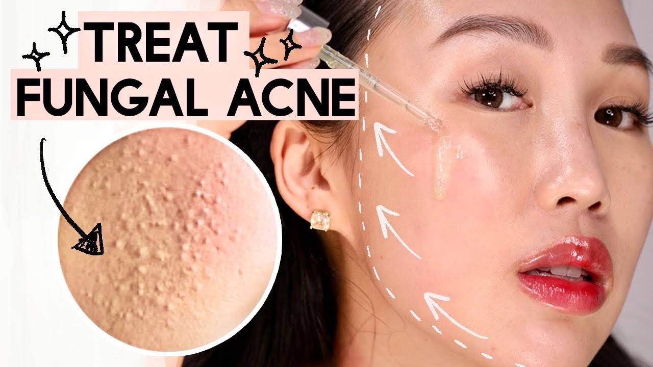 How to *Get Rid of Acne*, Textured Skin, Rid of Bumps 😡 Korean Skincare to Treat Fungal Acne