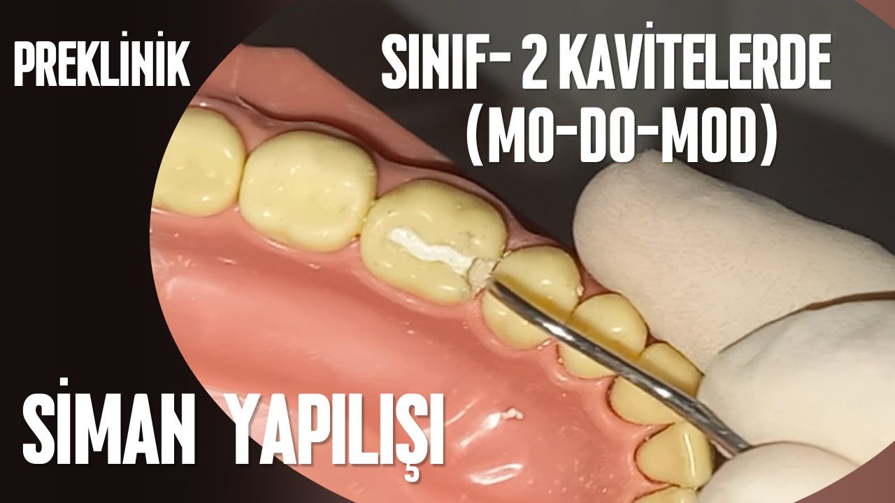 İkinci Sınıf Kavitelere (MO-DO-MOD) Siman Yapılışı
