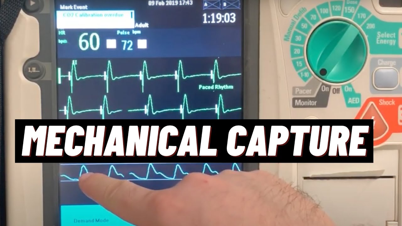How to Confirm Mechanical Cardiac Capture for Transcutaneous Pacing TCP on Philips HeartStart MRx?