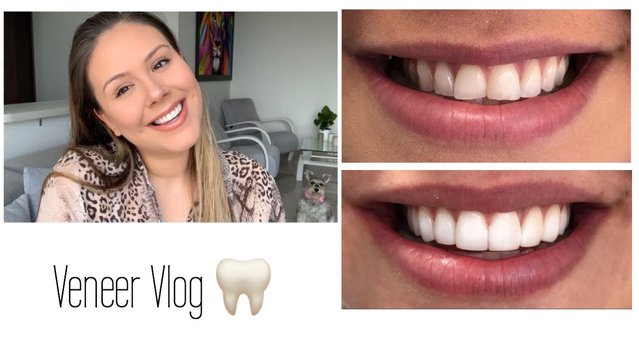 MY VENEERS EXPERIENCE | SMILE TRANSFORMATION | 🦷
