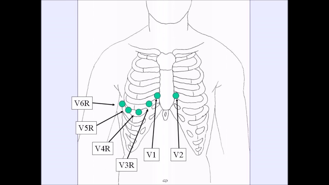 How To:  Complete Right Side ECG
