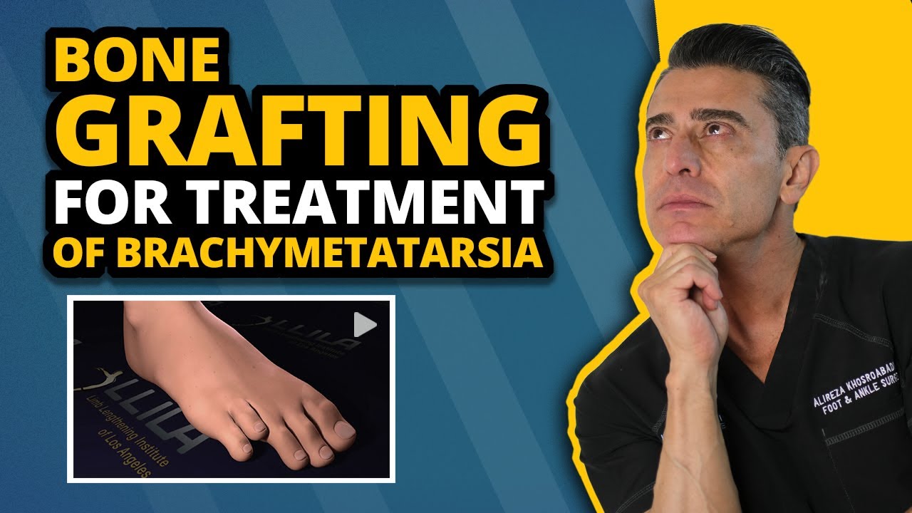 Brachymetatarsia - A Bone Grafting Process to Treat It