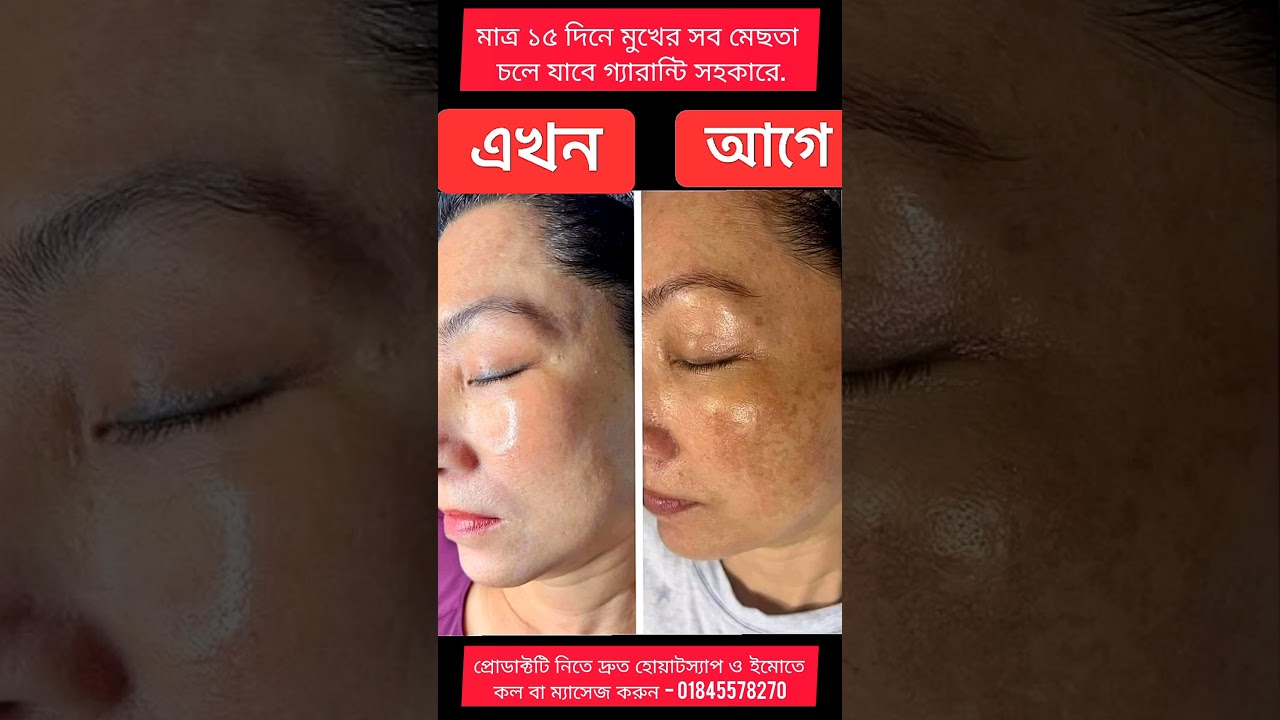 মেছতা, কালো দাগ, ব্রণের দাগ, তিলের দাগ, বয়সের ছাপ, শ্যামলা ত্বক উজ্জ্বল করণ গ্যারান্টি সহ সমাধান।