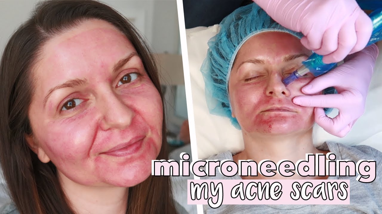 Vlog: Microneedling My Acne Scars | Esthetician Experience