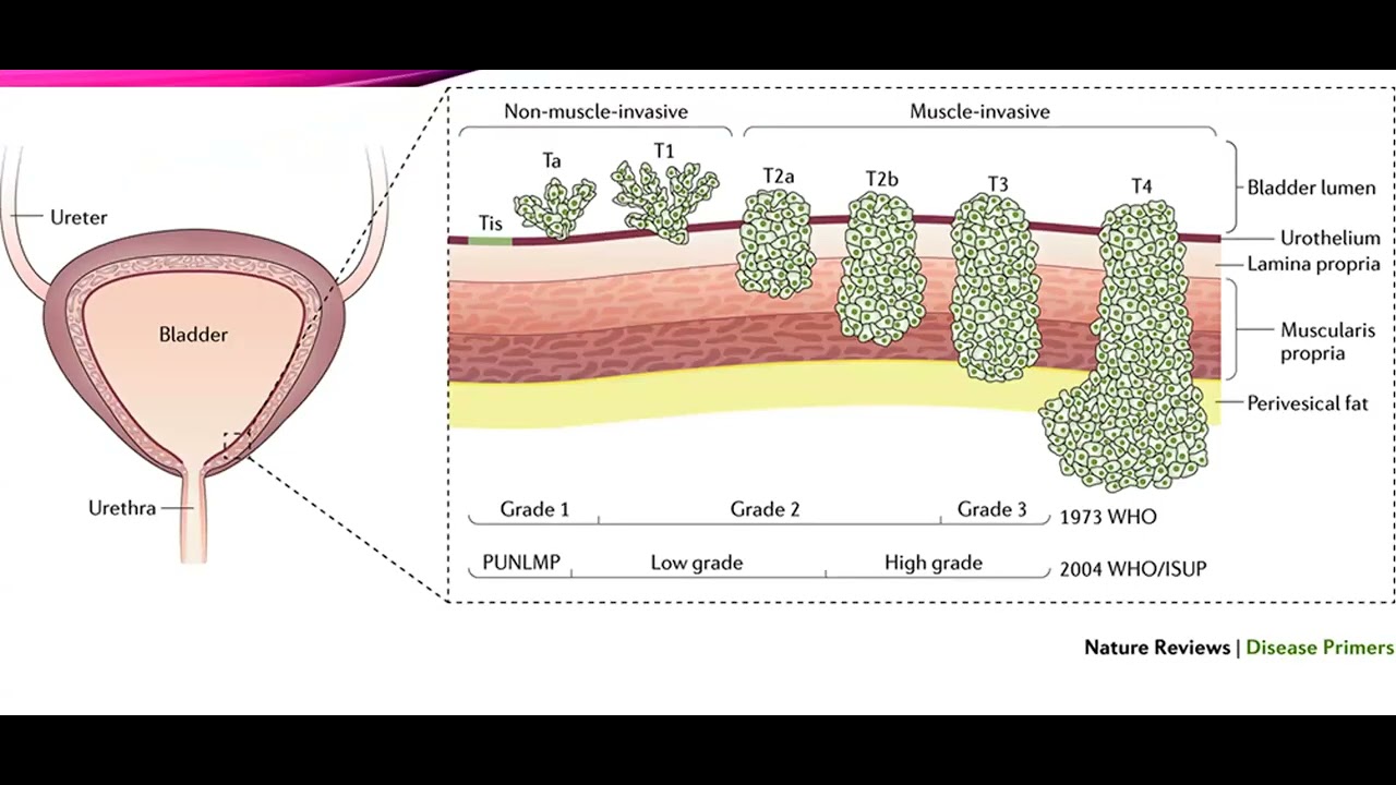 BCG in Bladder Cancer  Segment 0 x264