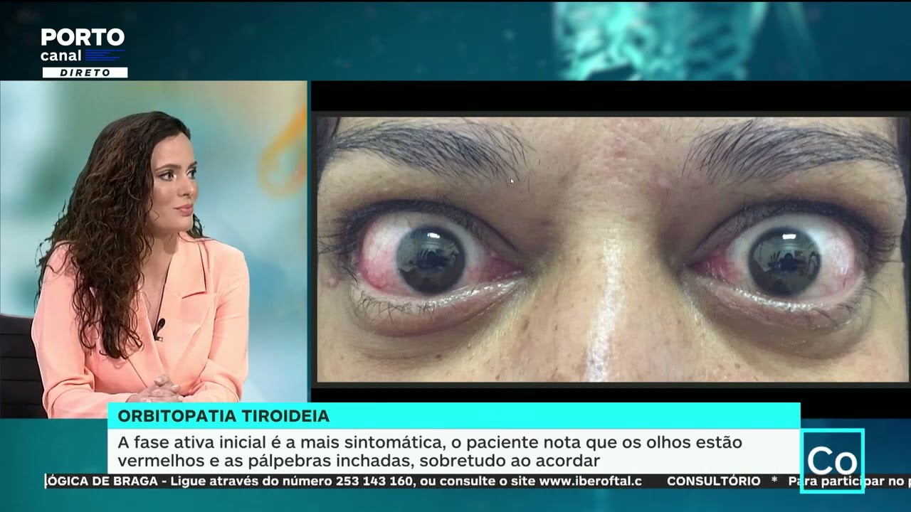 Orbitopatia Tiroideia  |  Dr.ª Cristina Sousa