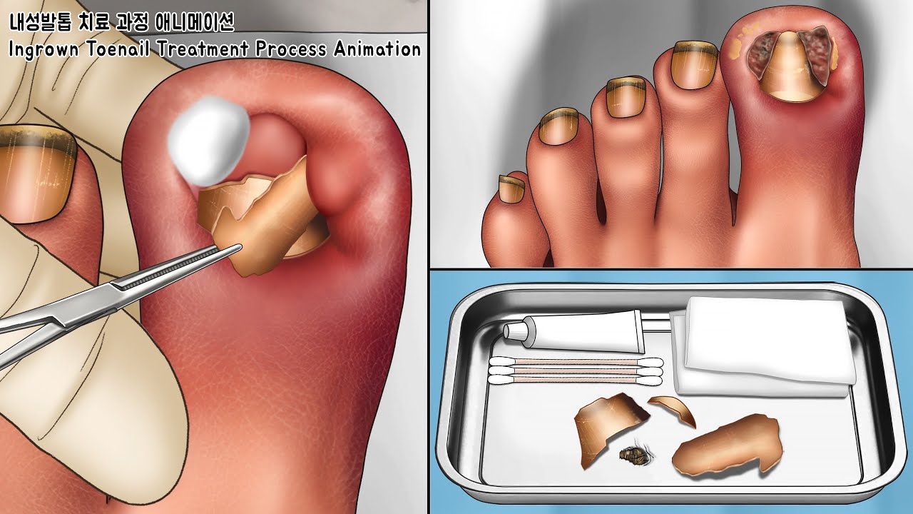 ASMR Treating Ingrown Toenails Caused by Tight Shoes Animation | Toenail Scaling