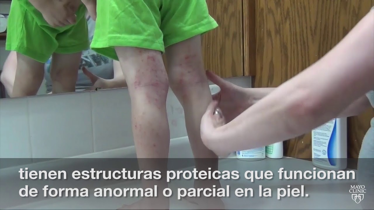 El minuto de Mayo Clinic: Entender el eccema infantil