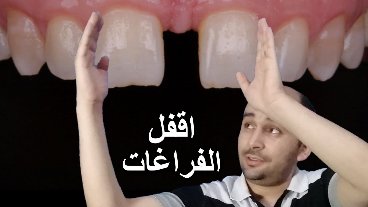 علاج الفراغات بين الاسنان الامامية | سد الفراغات بين الاسنان
