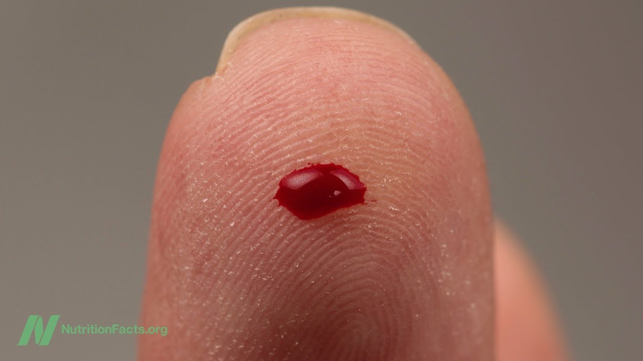 Benefits of Brewers Yeast for Diabetes