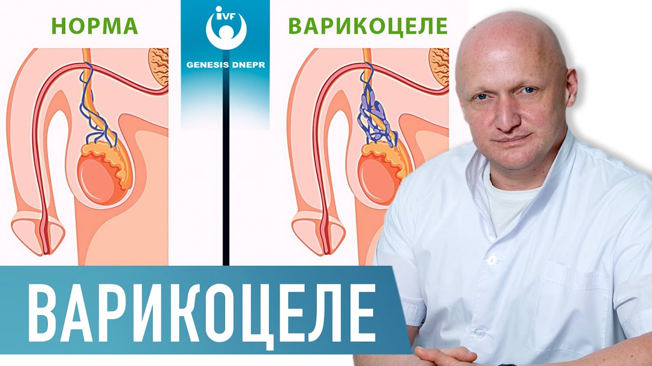Варикоцеле у мужчин. Опасности, диагностика и лечение. Операция Мармара |  Хирург Щевцов  А.Н.