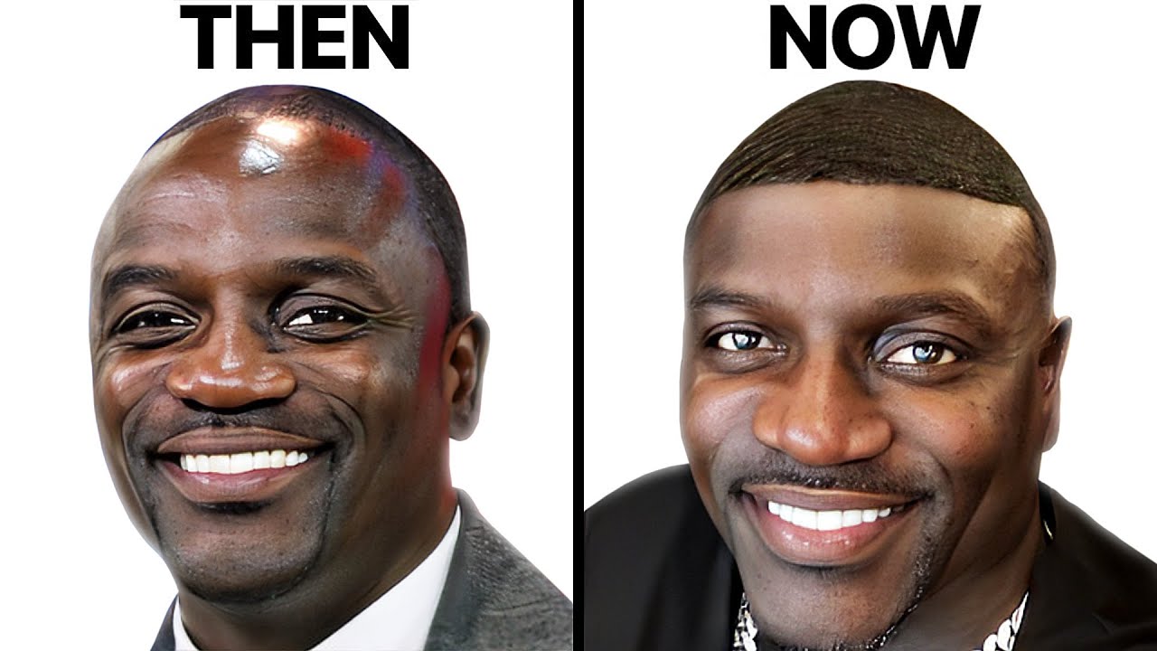 What Happened to Akon's Hair? Hair Transplant Analysis