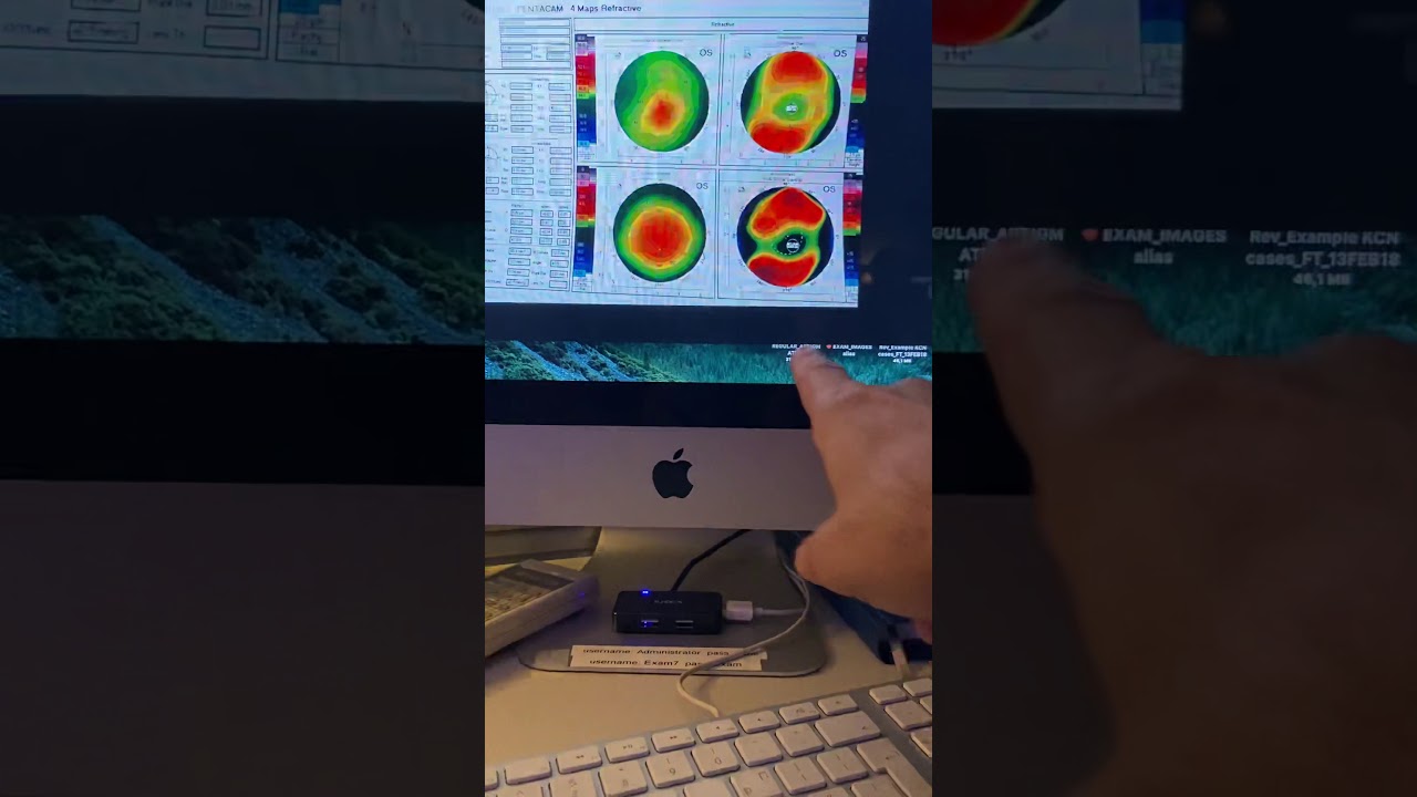 Confusion when evaluating effective  keratoconus fix with the Athens protocol CXL Kanellopoulos MD
