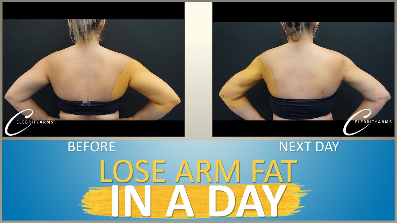Portugu&ecirc;s Patient | Lipo 360&deg; Arms | Arm Liposuction Results | Celebrity Arms&trade; | Expert Dr. Su