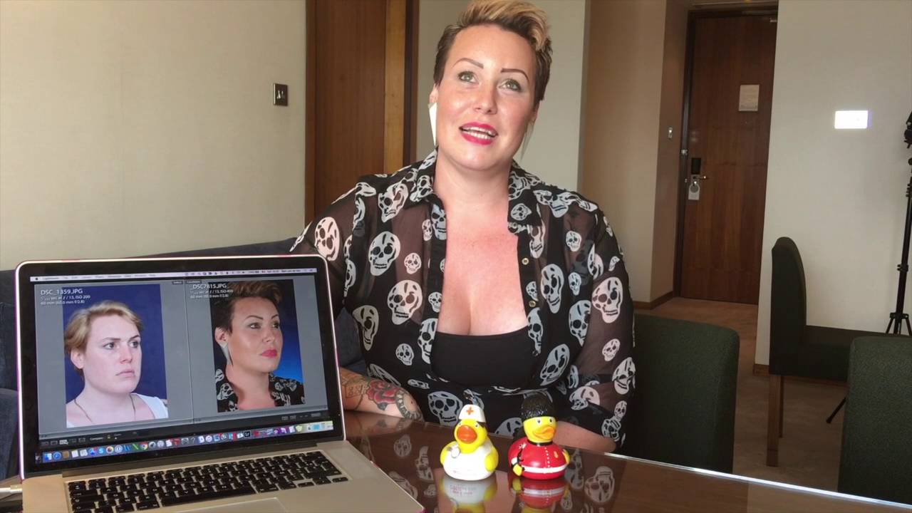 Facial Feminization Surgery Review - Alexia, Dr Bart van de Ven reviews