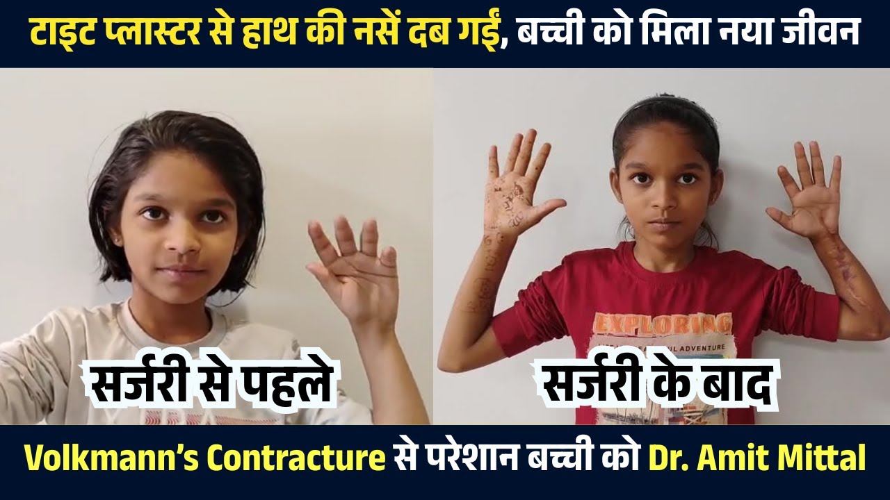 टाइट प्लास्टर की वजह से बिगड़ा हाथ | Dr. Amit Mittal की सर्जरी से मिली राहत | Volkmann’s Ischemic