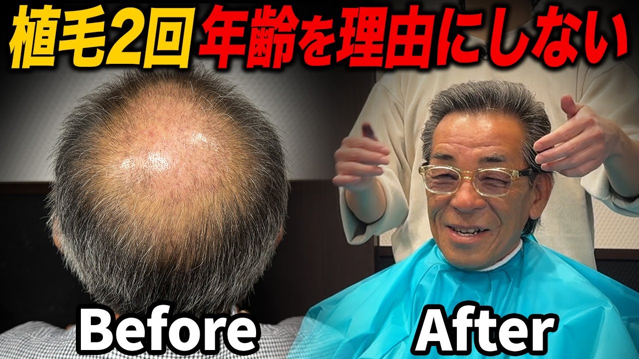【60代薄毛】植毛2回目8ヶ月経過｜男性として諦めない生き様
