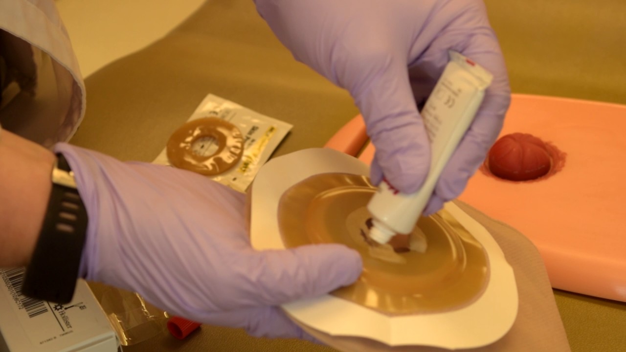 Stoma Care, Ileal Conduit